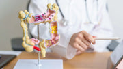 Diverticulitis. Tratamiento.