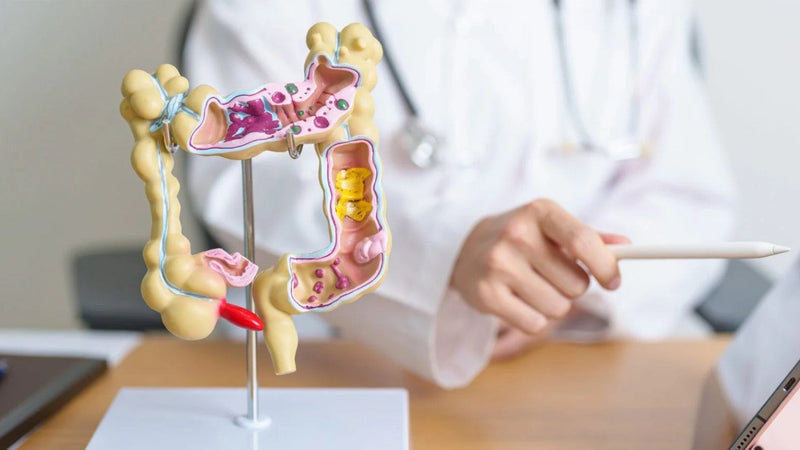 Diverticulitis. Tratamiento.